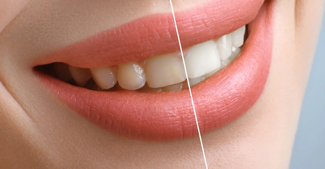 Naturalne sposoby wybielania zębów – co naprawdę działa, a czego unikać?